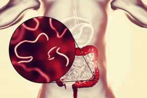 Ilustrasi cacingan. (Sumber: istimewa)