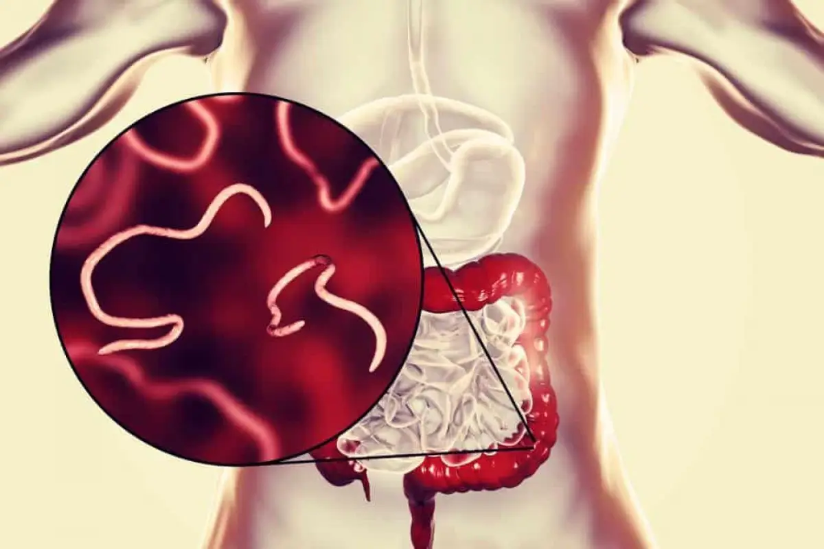 Ilustrasi cacingan. (Sumber: istimewa)